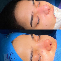 جراحی-بینی-70