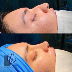 جراحی-بینی-71