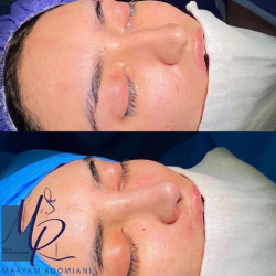 جراحی-بینی-74