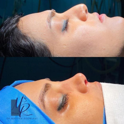 جراحی-بینی-75