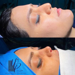 جراحی-بینی-76