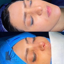 جراحی-بینی-77