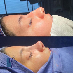 جراحی-بینی-79