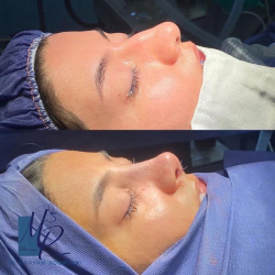 جراحی-بینی-80
