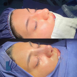 جراحی-بینی-81