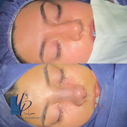 جراحی-بینی-82