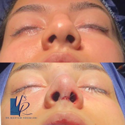 جراحی-بینی-83