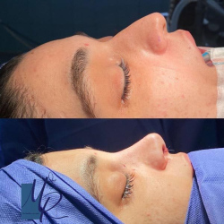 جراحی-بینی-84