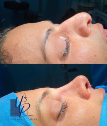 جراحی-بینی-87