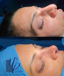 جراحی-بینی-88