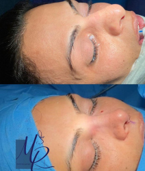 جراحی-بینی-89