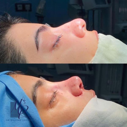 جراحی-بینی-93