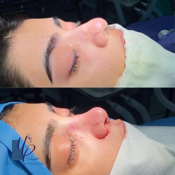 جراحی-بینی-94