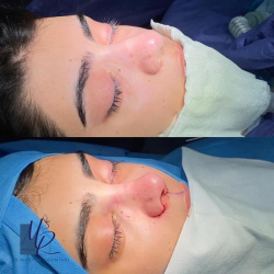 جراحی-بینی-95