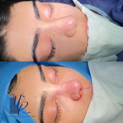 جراحی-بینی-96