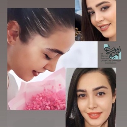 Rhinoplasty-1