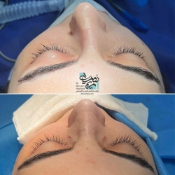 Rhinoplasty-10