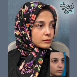 Rhinoplasty-100
