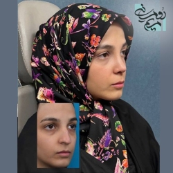 Rhinoplasty-101