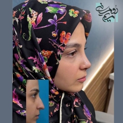 Rhinoplasty-102