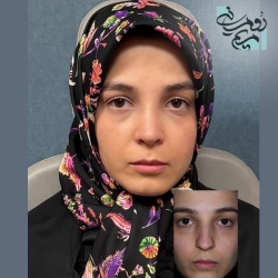 Rhinoplasty-103