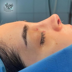Rhinoplasty-11