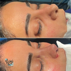 Rhinoplasty-12