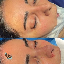 Rhinoplasty-13