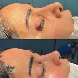 Rhinoplasty-14