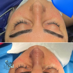 Rhinoplasty-15