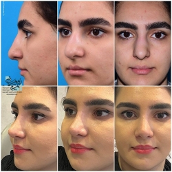 Rhinoplasty-16