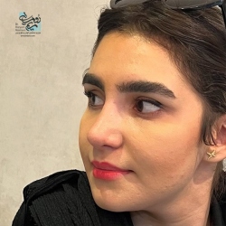 Rhinoplasty-18