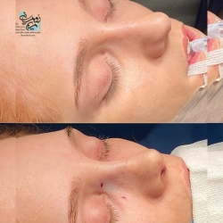 Rhinoplasty-19