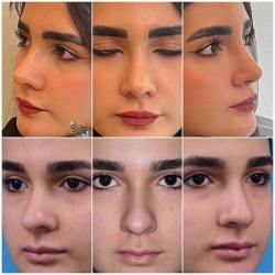 Rhinoplasty-2