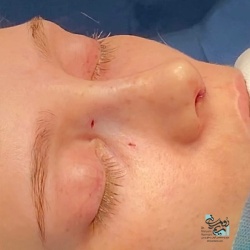 Rhinoplasty-20