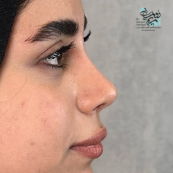 Rhinoplasty-21