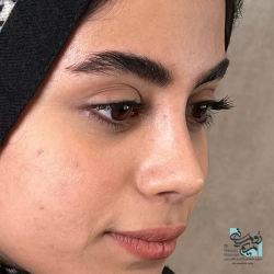 Rhinoplasty-22