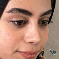 Rhinoplasty-23