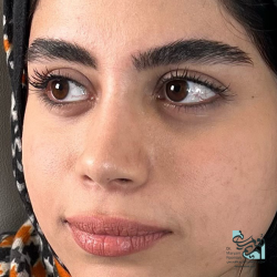 Rhinoplasty-24