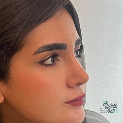 Rhinoplasty-3