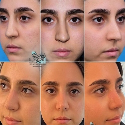 Rhinoplasty-4
