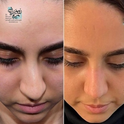 Rhinoplasty-5