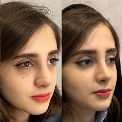 Rhinoplasty-54