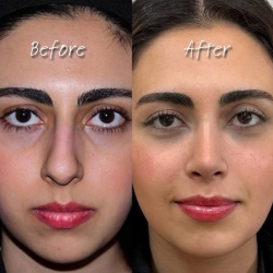 Rhinoplasty-55