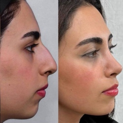 Rhinoplasty-56