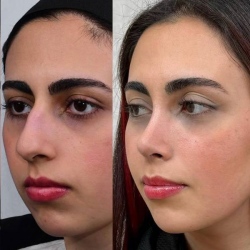 Rhinoplasty-57