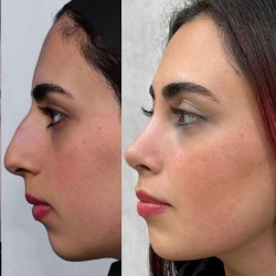 Rhinoplasty-58