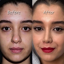 Rhinoplasty-59