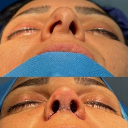 Rhinoplasty-62