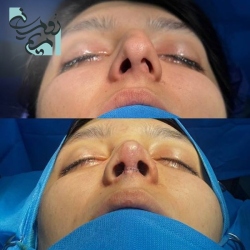 Rhinoplasty-65